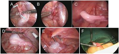 Comparison of Two Types of Staged Laparoscopic Orchiopexy for High Intra-Abdominal Testes in Children: A Retrospective Study From a Single Center